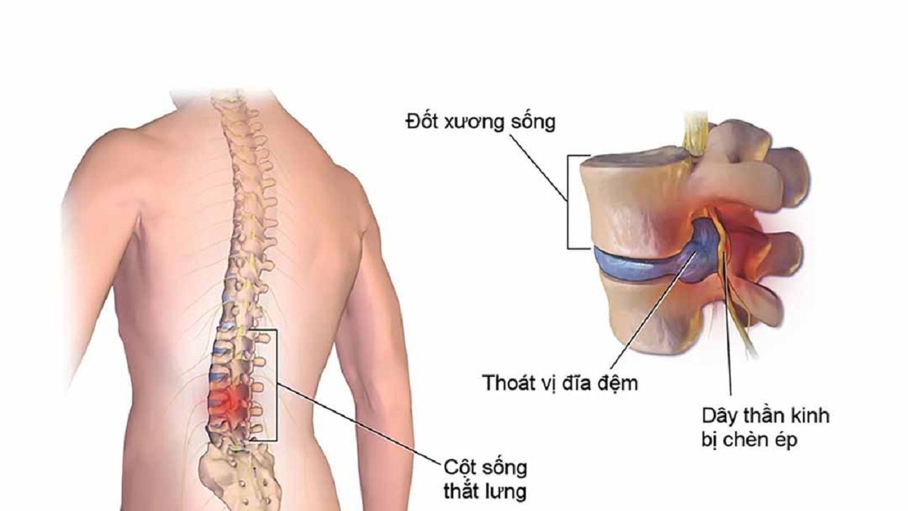 Khi nào cần chụp cộng hưởng từ cột sống thắt lưng?