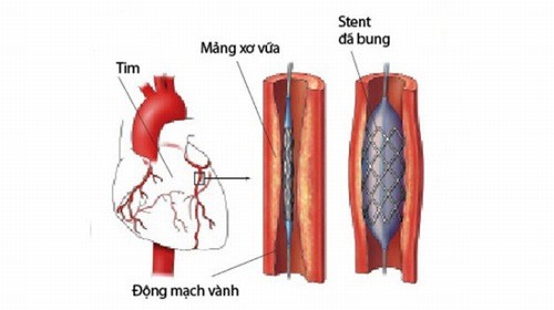 Khi nào cần đặt stent mạch vành?