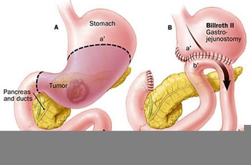 Khi nào cần mổ dạ dày?