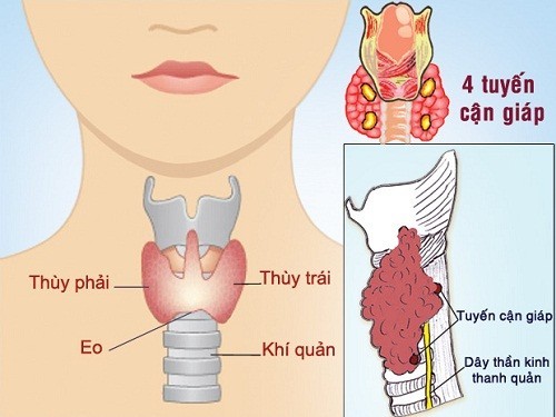 Khi nào cần mổ u tuyến giáp? loại phẫu thuật nào