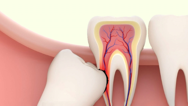 Khi nào cần nhổ răng khôn mọc thẳng và lưu ý