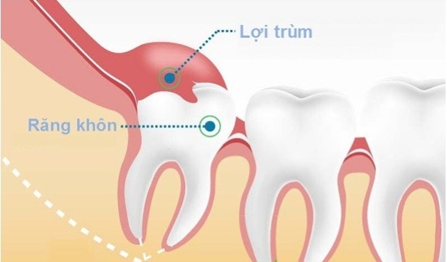 Khi nào cần nhổ răng khôn mọc thẳng và lưu ý