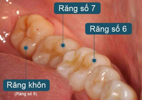 Khi nào có răng khôn và lưu ý cần biết