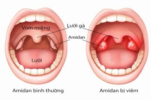 Khi nào nên cắt amidan? các biến chứng nguy hiểm