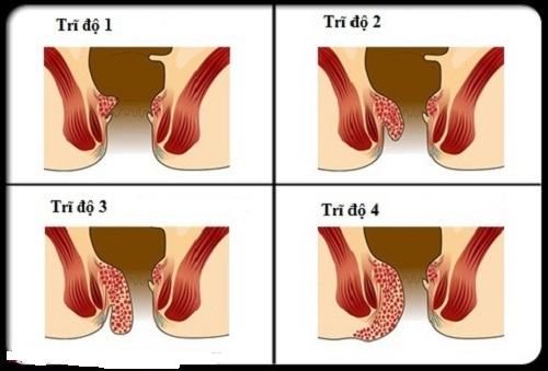 Khi nào nên mổ bệnh trĩ nội?