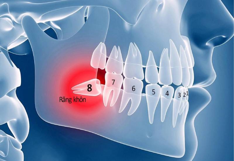 Khi nào nên nhổ răng khôn – Giải đáp từ bác sĩ