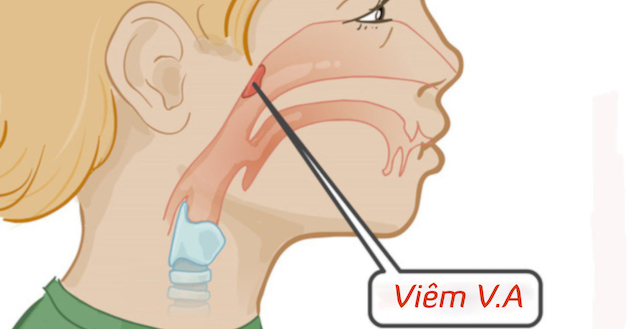 Khi nào nên tiến hành nạo VA cho trẻ?