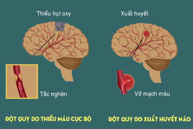 Khó ngủ đau đầu kéo dài tăng nguy cơ đột quỵ