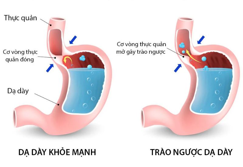 Khó nuốt nước bọt: Căn nguyên và cách cải thiện