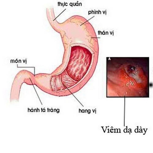 Khỏi bệnh dạ dày mạn tính sau 7 năm điều trị