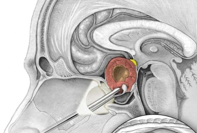 Khối u tuyến yên có nguy hiểm không và cách điều trị