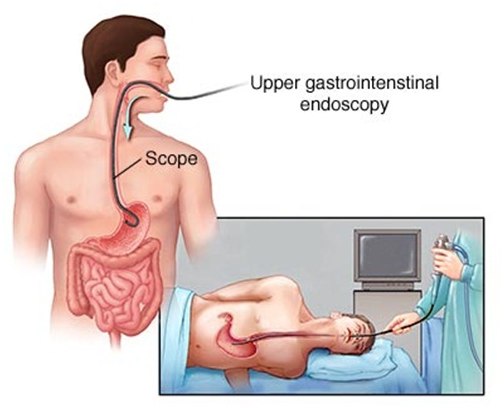 Không còn sợ mỗi lần nội soi dạ dày