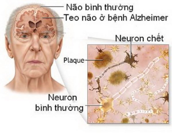 Không thể chủ quan trước sa sút trí tuệ ở người cao tuổi