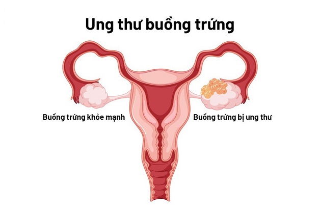 Kiểm tra tầm soát ung thư buồng trứng như thế nào?