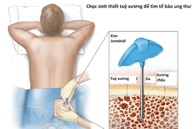 Kiểm tra ung thư sớm bằng cách nào để giúp phòng ngừa bệnh?