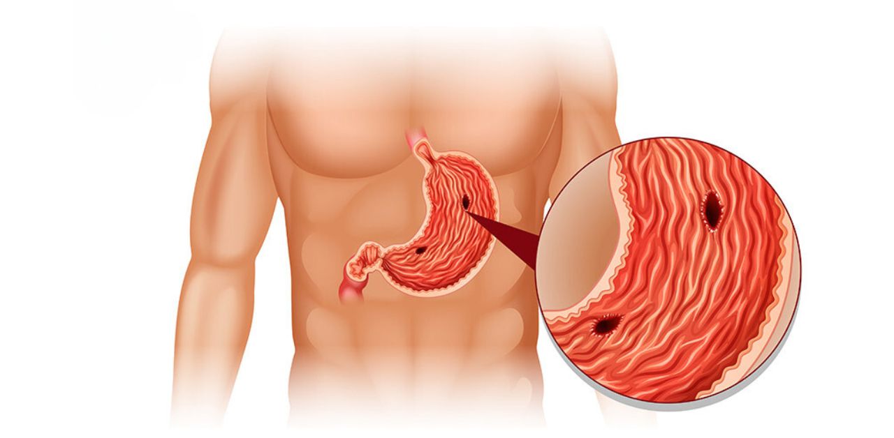 Kiến thức cần biết về viêm loét dạ dày bệnh học