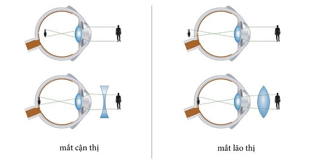 Kính lão thị và 4 điều cần lưu ý khi lựa chọn