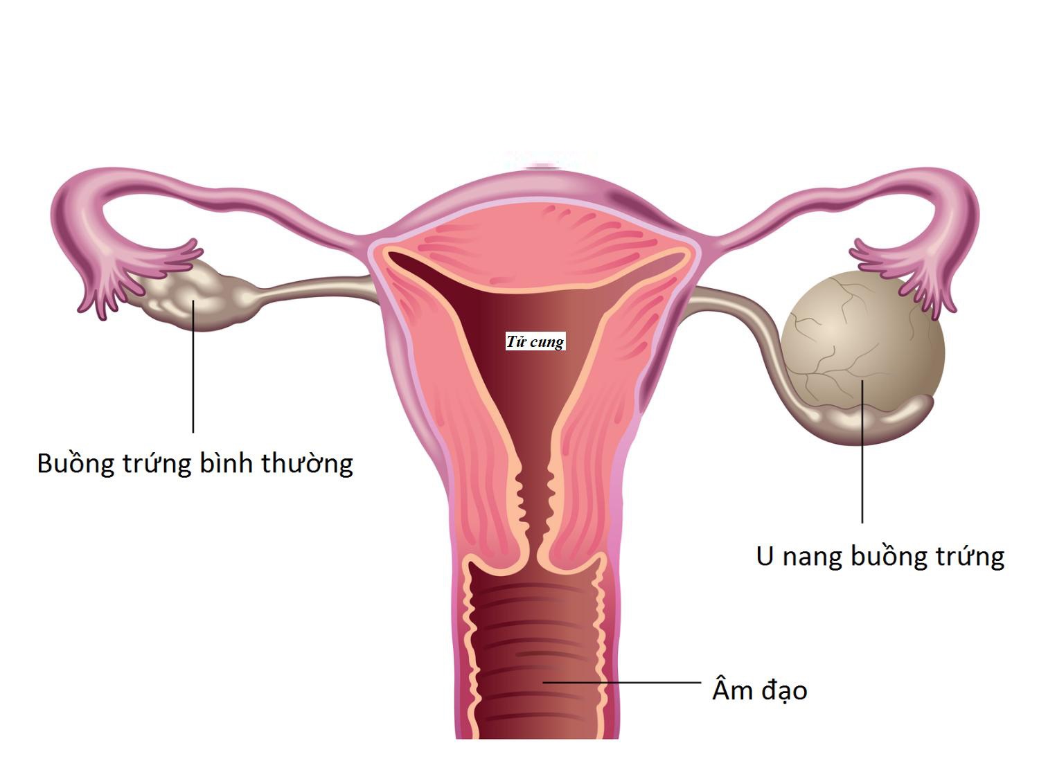 Kinh nghiệm cách chữa u nang buồng trứng theo dân gian