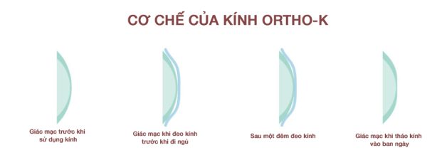 Kính Ortho K – cải thiện tật khúc xạ ngay trong lúc ngủ!