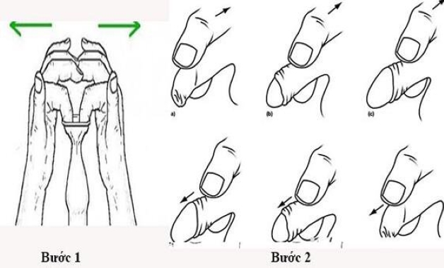 Kỹ thuật chữa hẹp bao quy đầu hiệu quả nhất cho nam giới