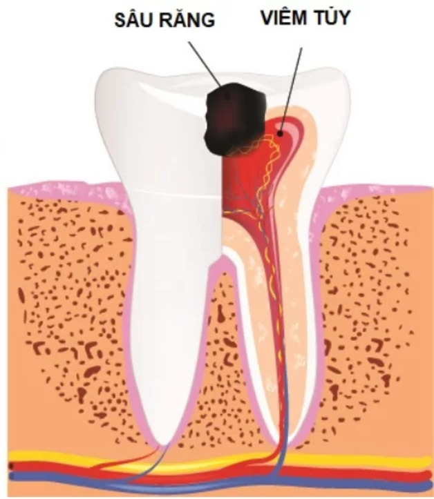 Kỹ thuật điều trị tủy răng chữa sâu răng nặng