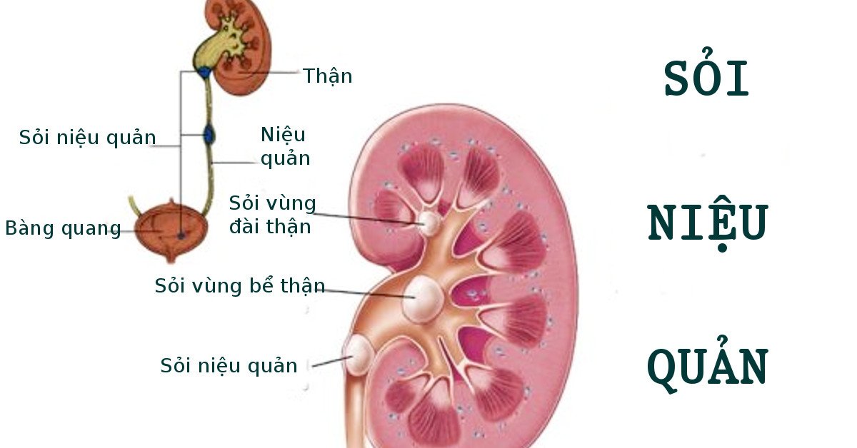 Kỹ thuật mổ nội soi lấy sỏi niệu quản thực hiện như thế nào?