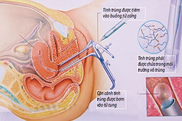 Kỹ thuật thụ tinh nhân tạo IUI – Hy vọng mới cho các cặp vợ chồng hiếm muộn