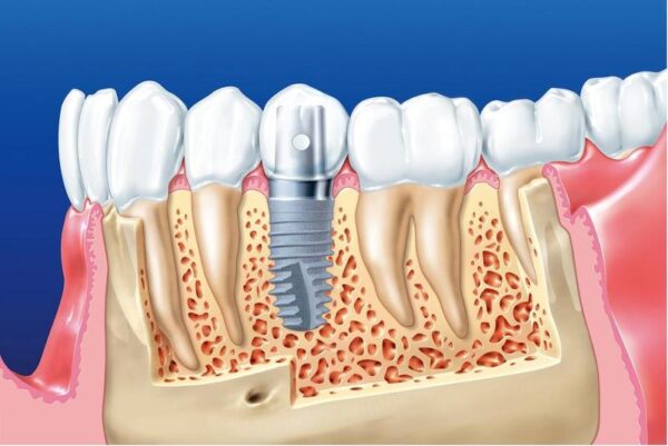 Kỹ thuật trồng răng implant và thông tin có thể bạn chưa biết