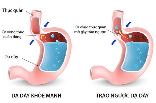 Làm gì khi trào ngược dạ dày gây rối loạn nhịp tim