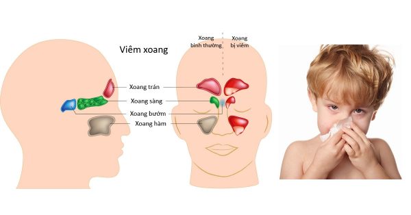 Làm gì khi trẻ sơ sinh bị nghẹt mũi?