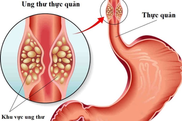 Làm rõ các phương pháp xét nghiệm ung thư thực quản