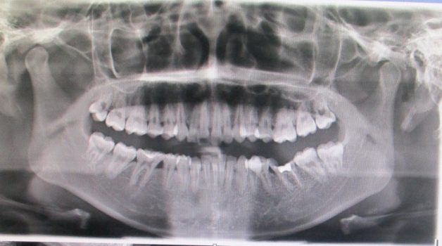 Làm sao để điều trị viêm quanh cuống răng dứt điểm?