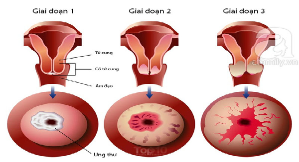Làm thế nào để chữa ung thư cổ tử cung?