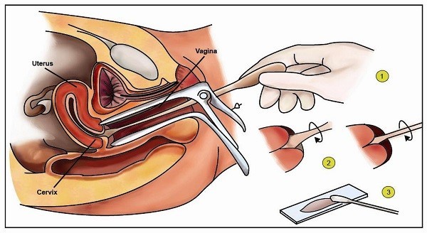 Làm thế nào để phát hiện sớm ung thư cổ tử cung?