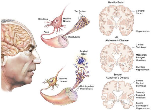 Làm thế nào ngăn chặn bệnh Alzheimer?