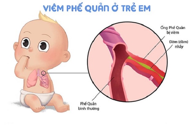 Lập kế hoạch chăm sóc bệnh nhân viêm phế quản cho trẻ tại nhà