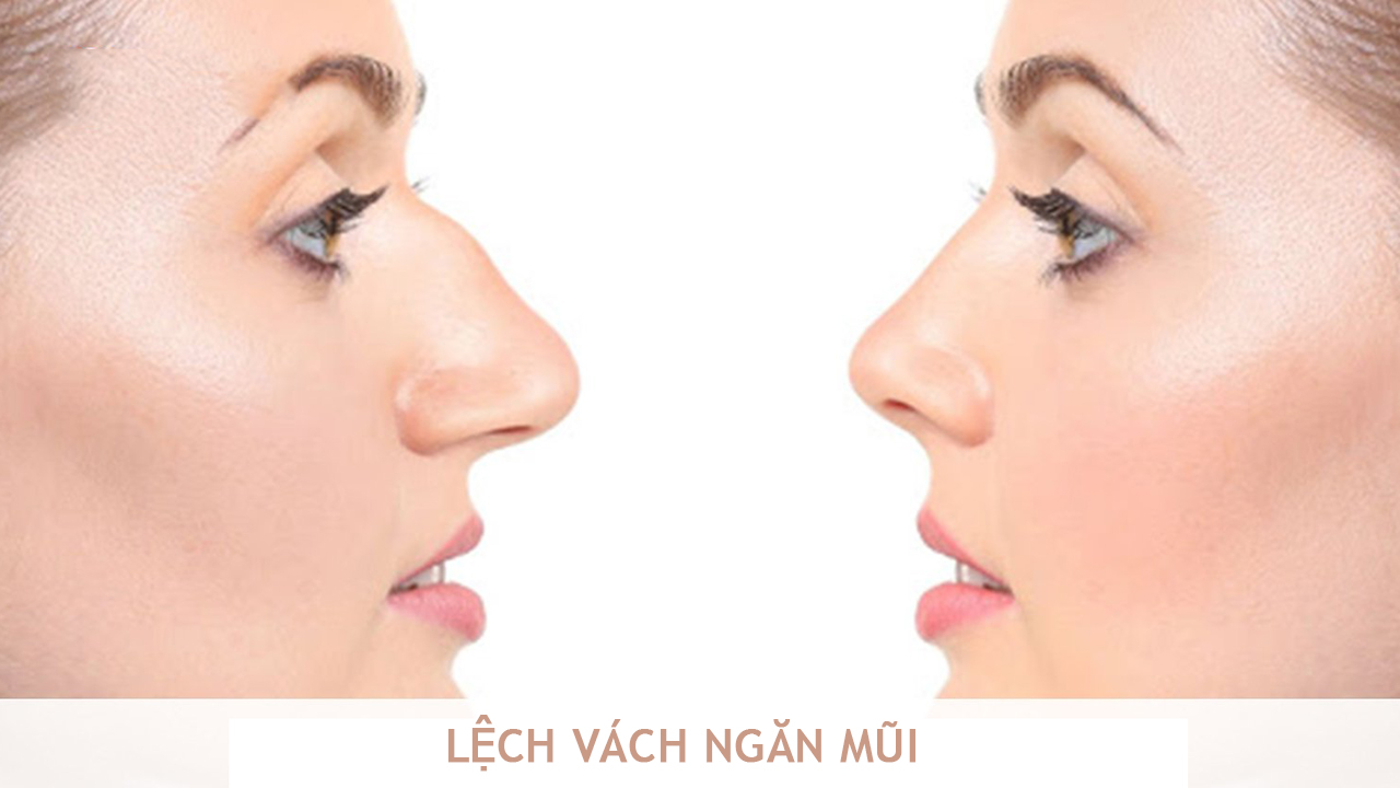 Lệch vách ngăn mũi: Nguyên nhân và cách điều trị