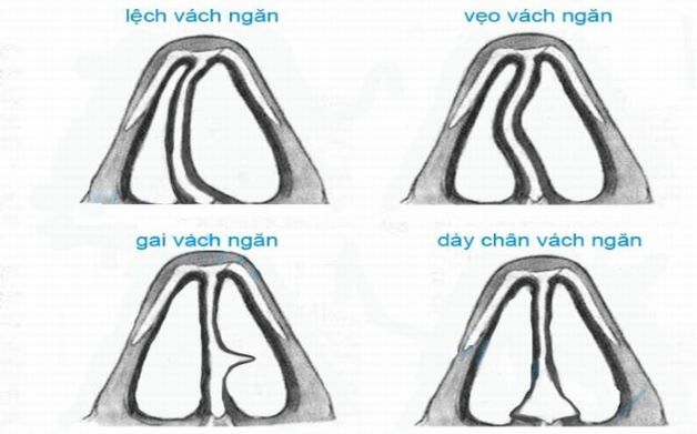 Lệch vách ngăn mũi: Nhận biết triệu chứng và cách điều trị