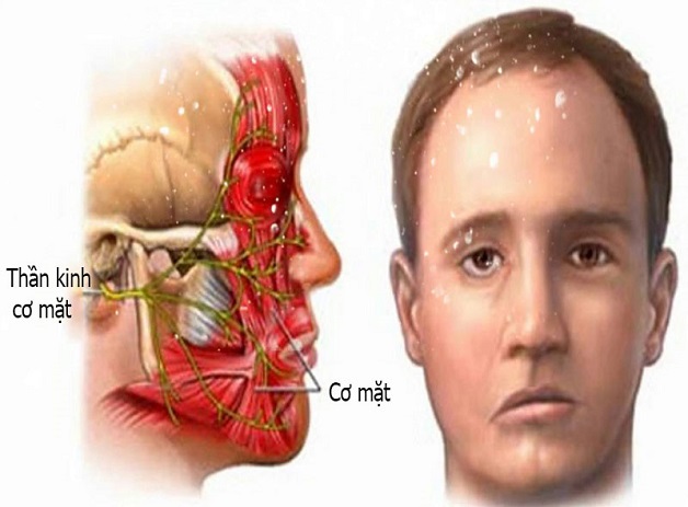 Liệt dây 7 ngoại vi: triệu chứng, nguyên nhân, điều trị