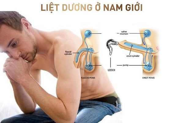 Liệt dương là gì, có chữa trị được không?