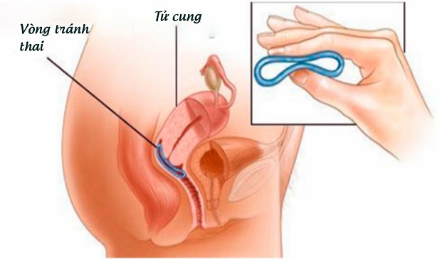 Liệu đặt vòng có dùng cốc nguyệt san được không?