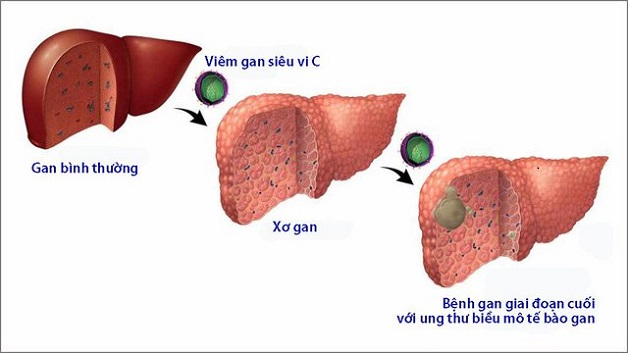 Liệu viêm gan C có lây qua đường ăn uống không?