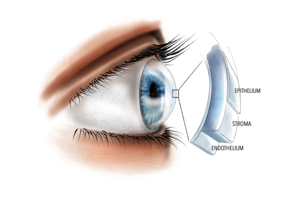 Loạn dưỡng giác mạc: Dấu hiệu, nguyên nhân, cách điều trị