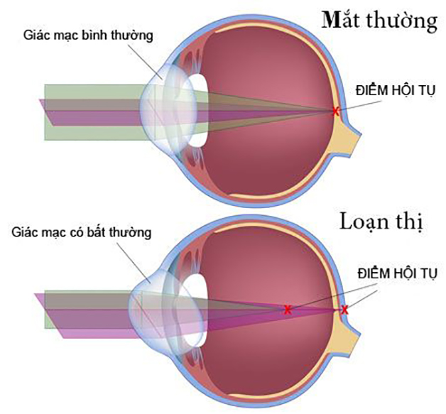 Loạn thị có giảm được không? Cách giảm độ loạn thị