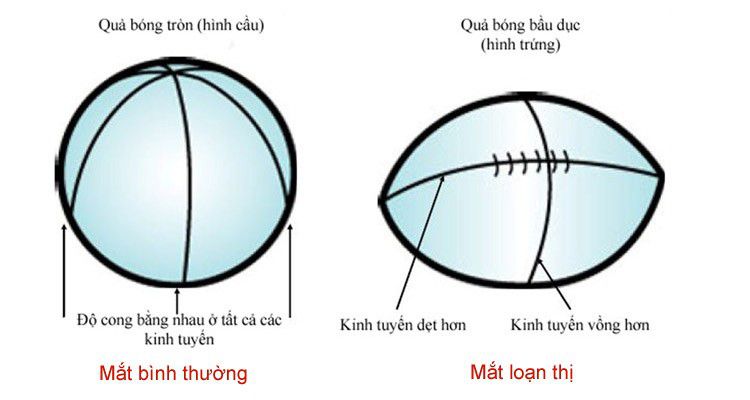 Loạn thị có tăng độ không? Cách kiểm soát tăng độ loạn thị