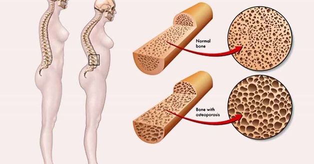 Loãng xương ở nam giới: Có hay không?