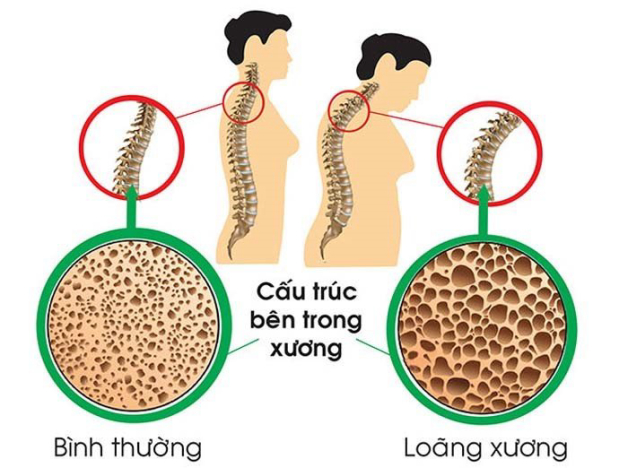 Loãng xương và cách điều trị bệnh nhất định phải biết