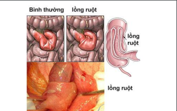 Lồng ruột – bệnh tiêu hoá ở trẻ em cần cấp cứu kịp thời