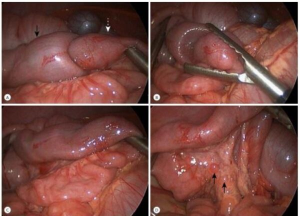 Lồng ruột – bệnh tiêu hoá ở trẻ em cần cấp cứu kịp thời