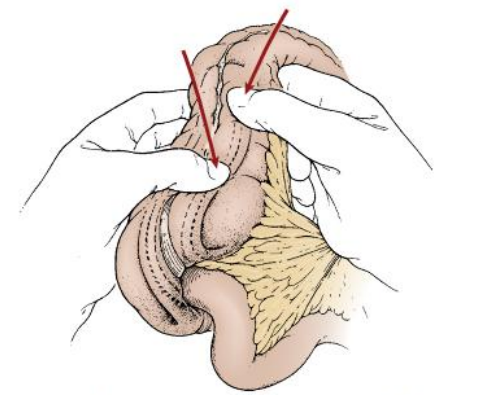 Lồng ruột – bệnh tiêu hoá ở trẻ em cần cấp cứu kịp thời